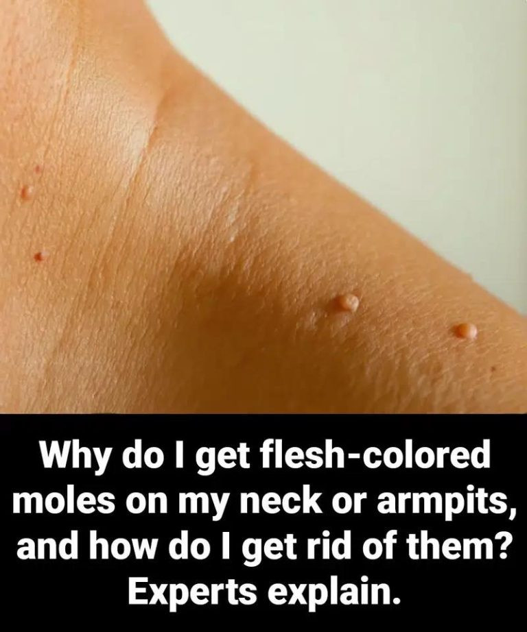 Why do I get flesh-colored moles on my neck or armpits, and how do I get rid of them? Experts explain.