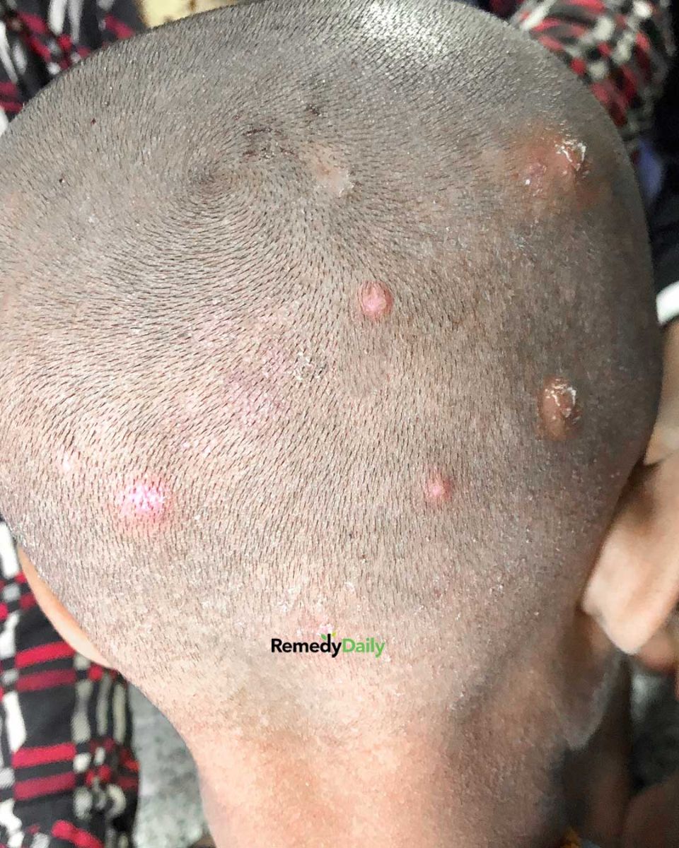 Found these bumps on my son’s scalp. Doctor appt is so far away. What’s should I do? They look really painful