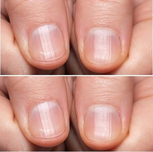 Having Striped Nails Could Mean That Your Body is…. See more