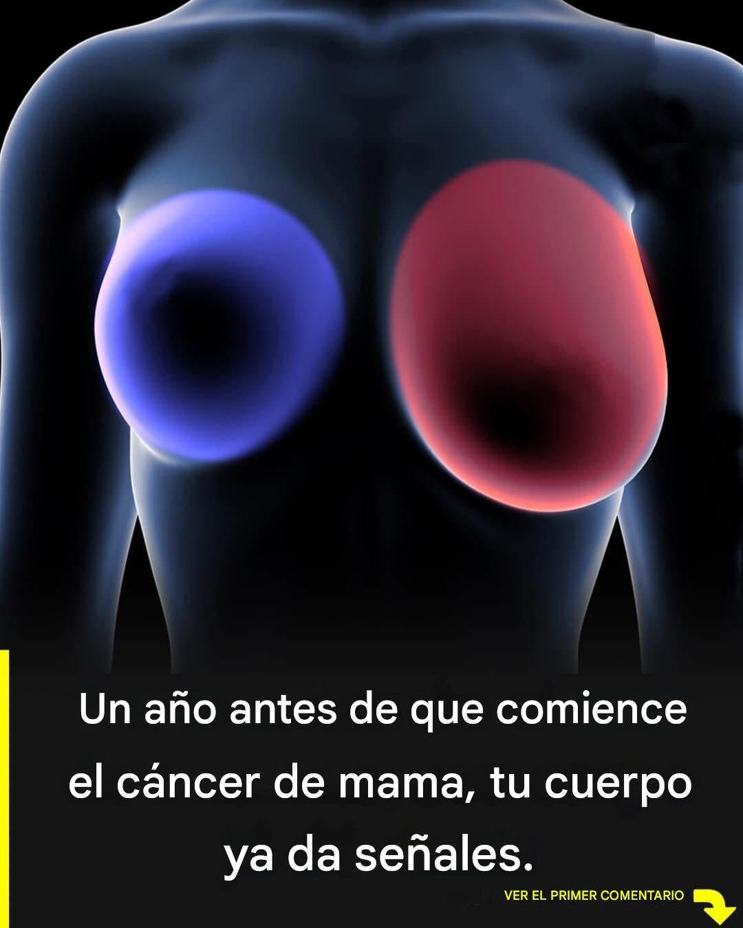Breast cancer: 4 early signs every woman should know.