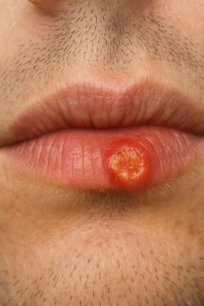 Crusty sore on my lip won’t go away. Appointment is impossible to get right now. What is this?