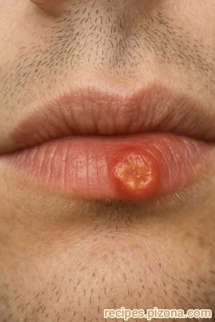 Crusty sore on my lip won’t go away. Appointment is impossible to get right now. What is this?